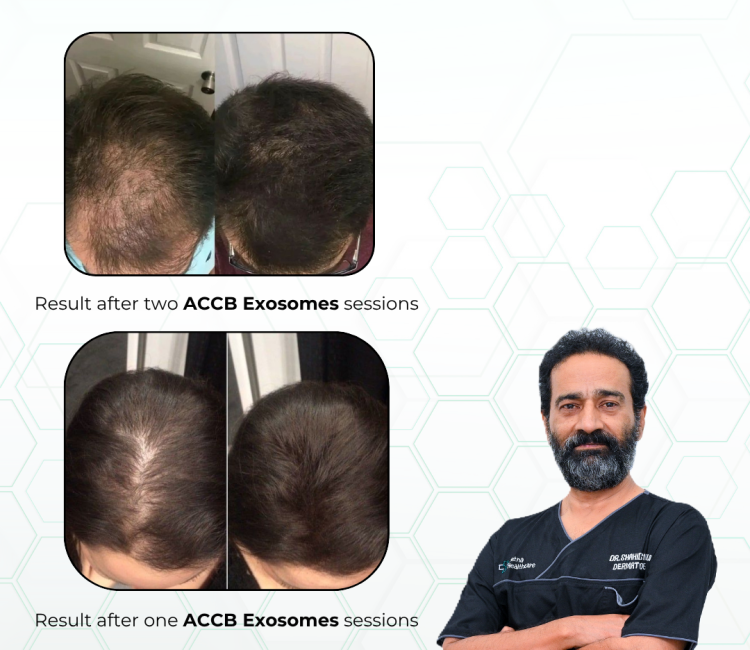 ourced from stem cells, exosomes are highly concentrated and deliver targeted signals to hair follicles, encouraging repair and regeneration at a cellular level